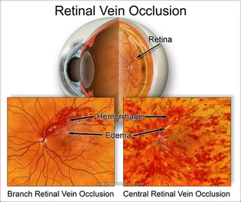 Central Retinal Vein Occlusion Information On Eye Conditions