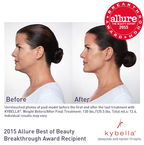Get rid of your stubborn double chin with Kybella | Kybella, Double chin treatment, Double chin