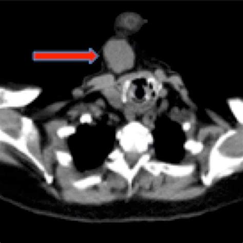 Axial Positron Emission Tomographycomputed Tomography Of The Neck