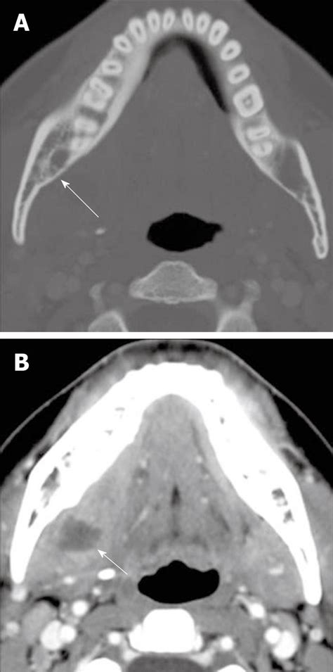 Computed Tomography Imaging Of Acute Neck Inflammatory Processes