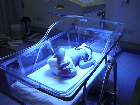 JAUNDICE IN THE NEWBORN (2)  Ask The Paediatricians