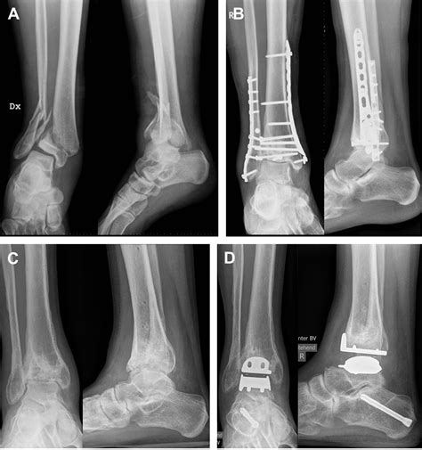 Ankle Osteoarthritis Foot And Ankle Clinics