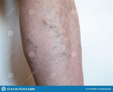 Leg Of Old Man With Varicose Veins Enlarged Swollen And Twisting