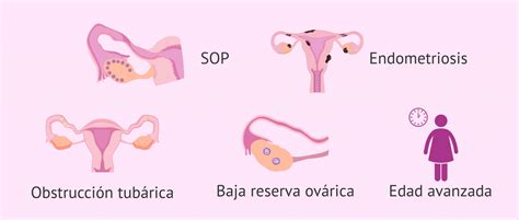 Tratamiento Segun Causa Infertilidad Femenina