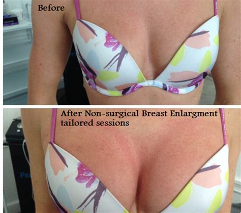 Non Surgical Breast Lift Sculpted Beauty