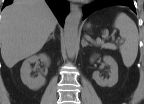 Bilateral Adrenal Adenomas Adrenal Case Studies Ctisus Ct Scanning