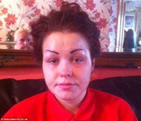 Woman Looks Like A Clown After Botched Eyebrow Tattoo Fillers Daily