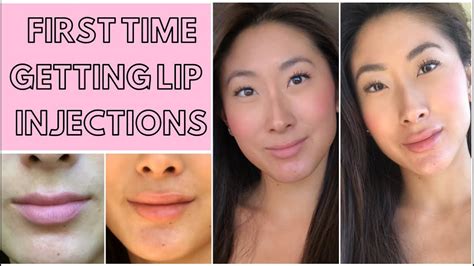 my lip filler and injections experience everything you need to know youtube