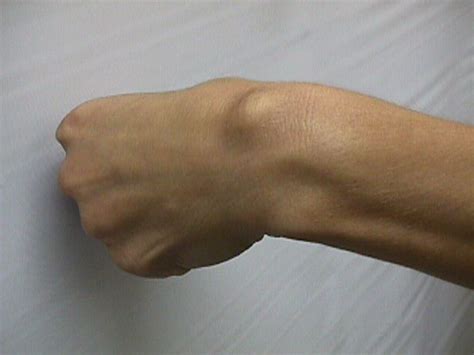 Tumor Dorsal Wrist Ganglion Cysts
