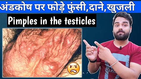 अडकष पर फड फस सफद दन खजल क इलज Pimples in the testicles Testicles Itching