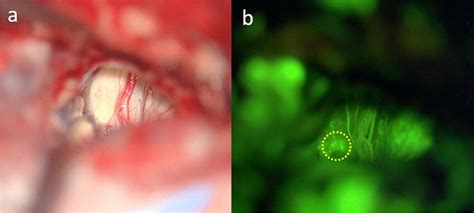 Intraoperative View Comparison With Fluorescence Visualization Of The