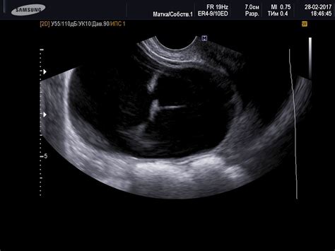 Septated Ovarian Cyst Ultrasound