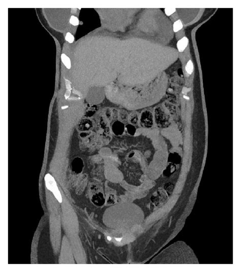 Abdominal Ct Scan With Evidence Of Small Bowel Intussusception