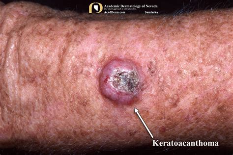 Keratoacanthoma Low Grade Squamous Cell Carcinomas Academic