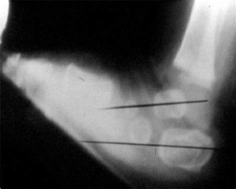 Clubfoot, or talipes equinovarus, is a congenital deformity consisting of hindfoot equinus, hindfoot varus, and forefoot varus. Clubfoot (congenital talipes equinovarus) - Pediatrics ...