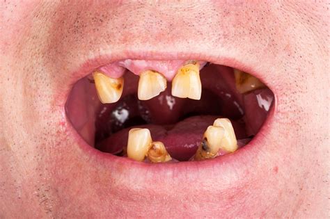 Gum Cancer From Dipping