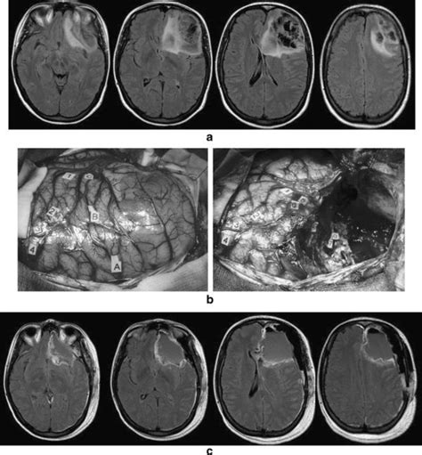Impact Of Facility Type And Volume In Low Grade Glioma Outcomes