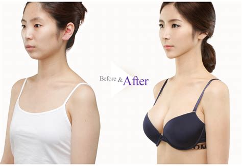 Teardrop Breast Augmentation Before And After Case