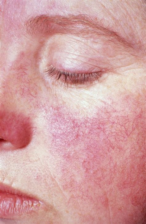 Cleveland Clinic Lupus Skin Rash On Face Pictures