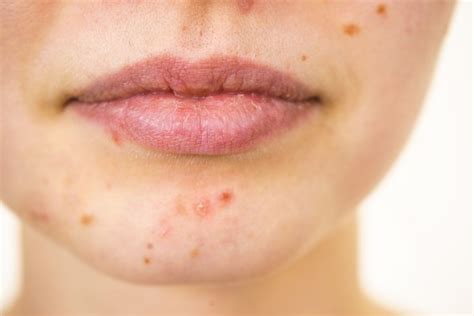 What Causes Acne In Adults And How To Treat It Phillyvoice
