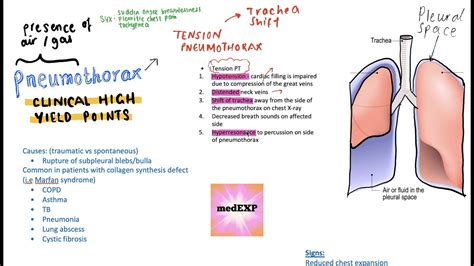 Pneumothorax Clinically Relevant High Yield Points Usmle Youtube