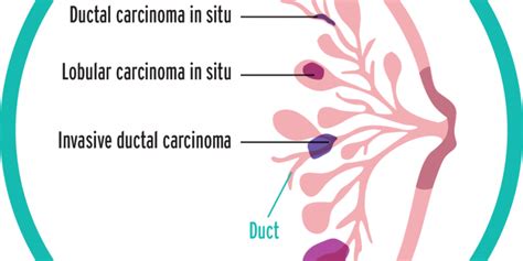 Common Types Of Breast Cancer Presentations Emabal Hospitals Limited