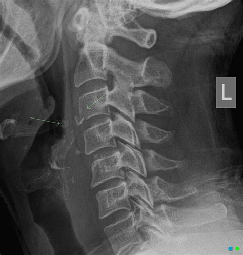 Extension Teardrop Fracture Cervical Spine Spine Orthobullets