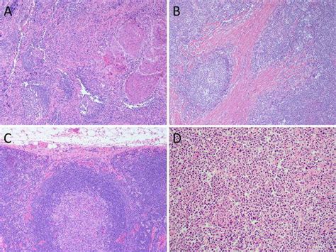 A Lymph Node Metastasis Of Squamous Cell Carcinoma Malignant Cells