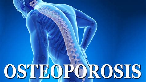 Osteoporosis Bone Disease Simple And Effective Natural Home Remedies