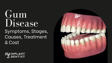 Gum Disease Symptoms Stages Causes Treatment Cost