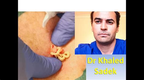 Cheesy Cyst Dr Khaled Sadek Youtube