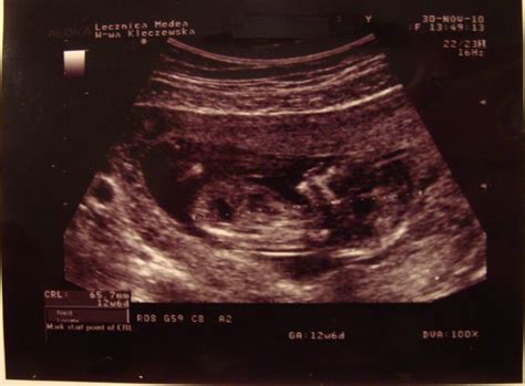 13 tydzień ciąży - kalendarz ciąży