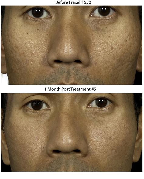 Fraxel New York Laser Skin Resurfacing