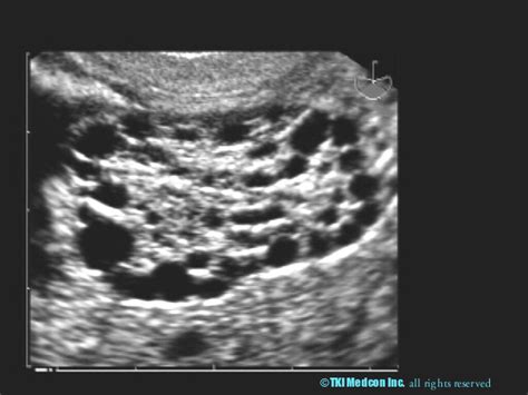 Adult Polycystic Kidney Disease Ultrasoundpaedia