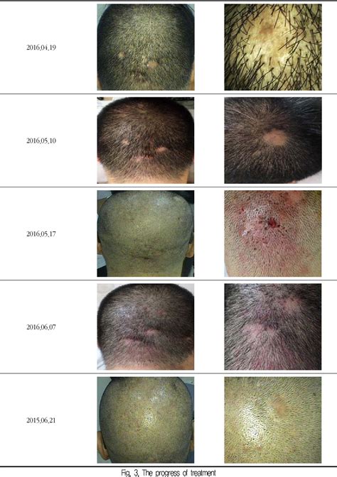 Figure 3 From A Case Of Scalp Folliculitis Treated By Korean Medicine