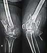 Distal Femur Fractures - Trauma - Orthobullets