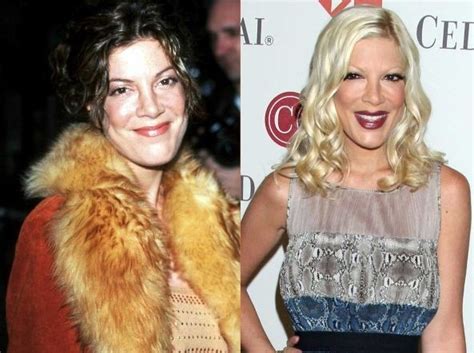 Tori Spelling Before And After Plastic Surgery 05 Celebrity Plastic