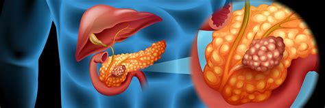Pancreatic cancer is a cancer that's found anywhere in the pancreas. Pancreatic cancer survival linked to four genes - http ...