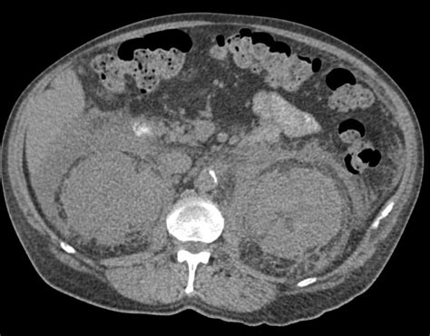 Retroperitoneal Fibrosis Kidney Case Studies Ctisus Ct Scanning