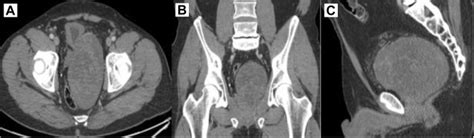 Leiomyoma Of The Prostate Case Report And Review Of The Literature Clinical Genitourinary Cancer