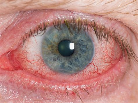 Symptoms range from mild and occasional to severe and continuous. Dry Eye Treatment | Alabama Vision Center