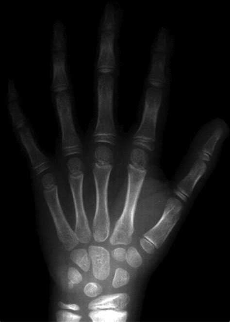 Bone Of Contention Can Wrist X Rays Really Reveal The Age Of People