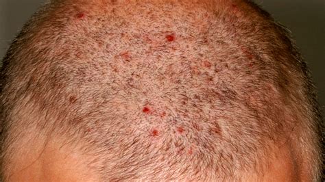 Why Do I Have Big Small Red Itchy Bumps On My Scalp American Celiac