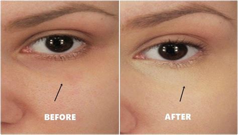 How To Get Rid Of Dark Circles Under Eyes No Makeup Saubhaya Makeup
