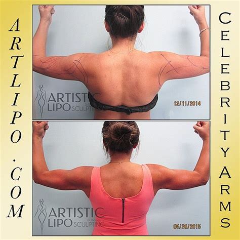 Artistic Liposuction Center Dr Thomas Su Google Celebrity Arms