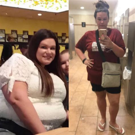 The Most Inspiring Gastric Bypass Before And After Photos