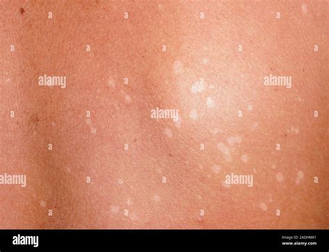 Pityriasis Versicolor Tinea Versicolor A Fungal Infection Producing