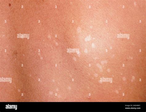 Pityriasis Versicolor Tinea Versicolor Une Infection Fongique