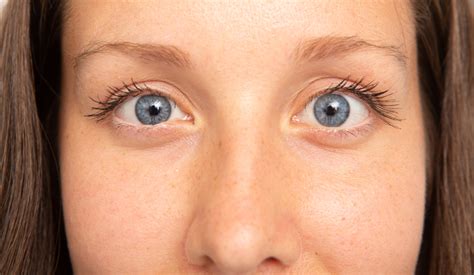 Treating Strabismus With Toxin Aesthetics
