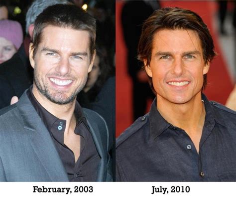 Tom Cruise Plastic Surgery Before And After Photos Nose